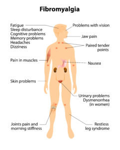 FIG 2 Fibromyalgia image