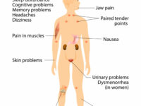 FIG 2 Fibromyalgia image