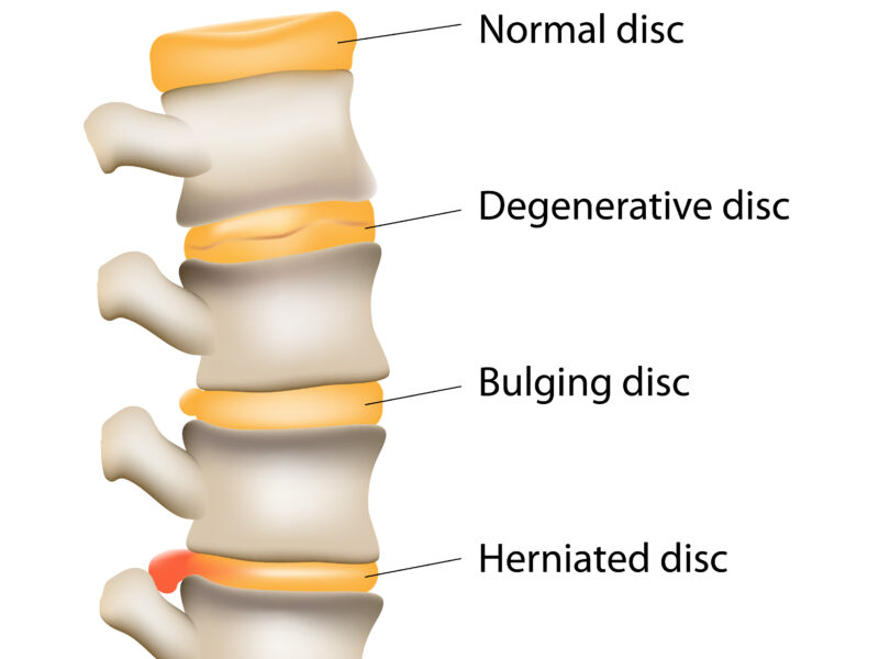 Herniated Disc