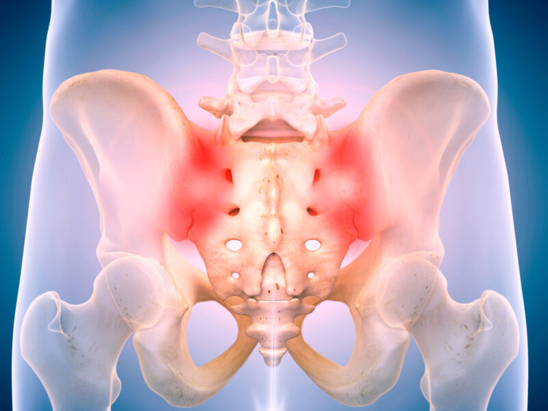 Sacroiliac Joint Dysfunction