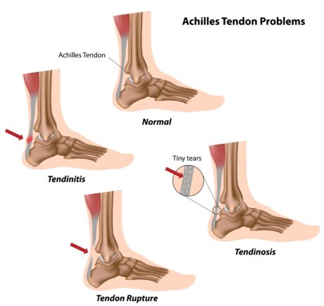 Jing Online Pathology Series: Achilles Tendinosis