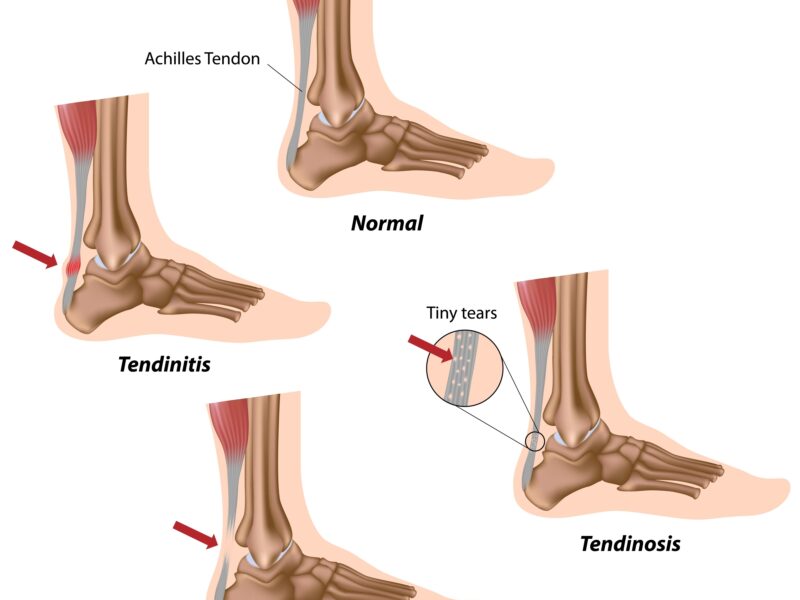 Achilles Tendinosis