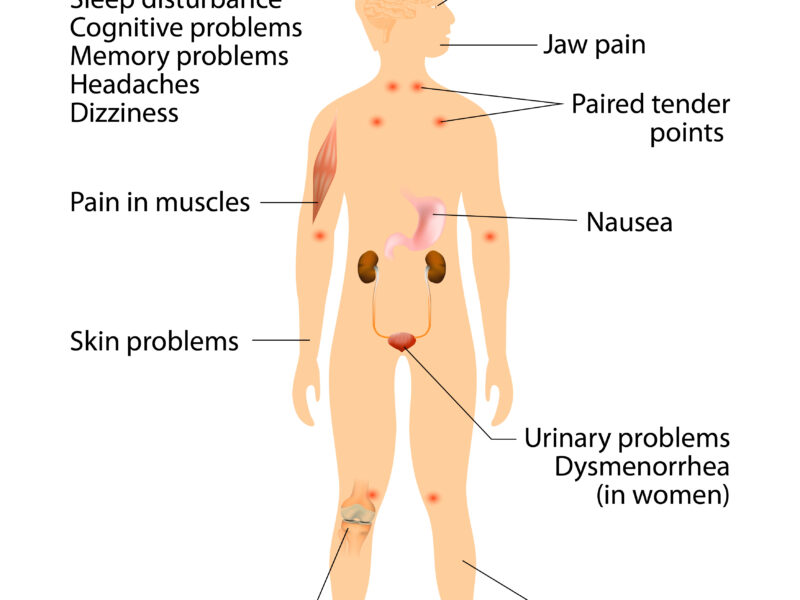 Fibromyalgia and CFS