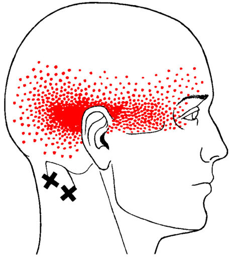 Jing Online Pathology Series: Headaches and Migraines