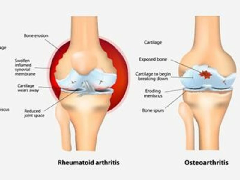Osteo and rheumatoid arthritis